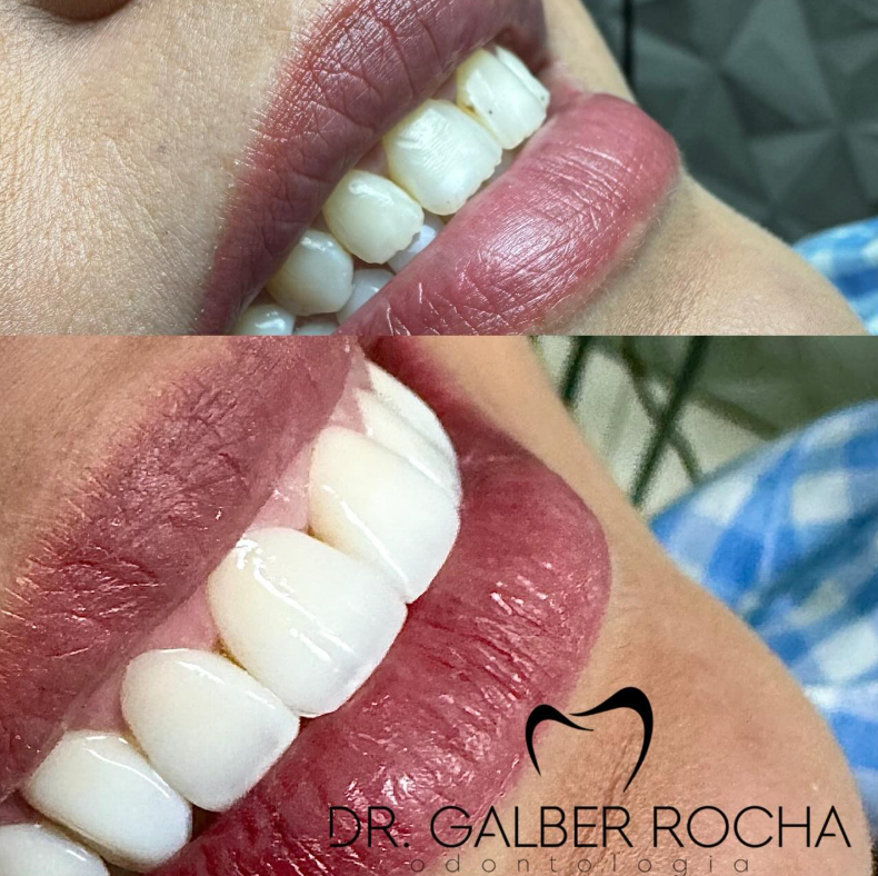 Antes e Depois