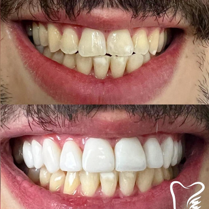 Antes e Depois