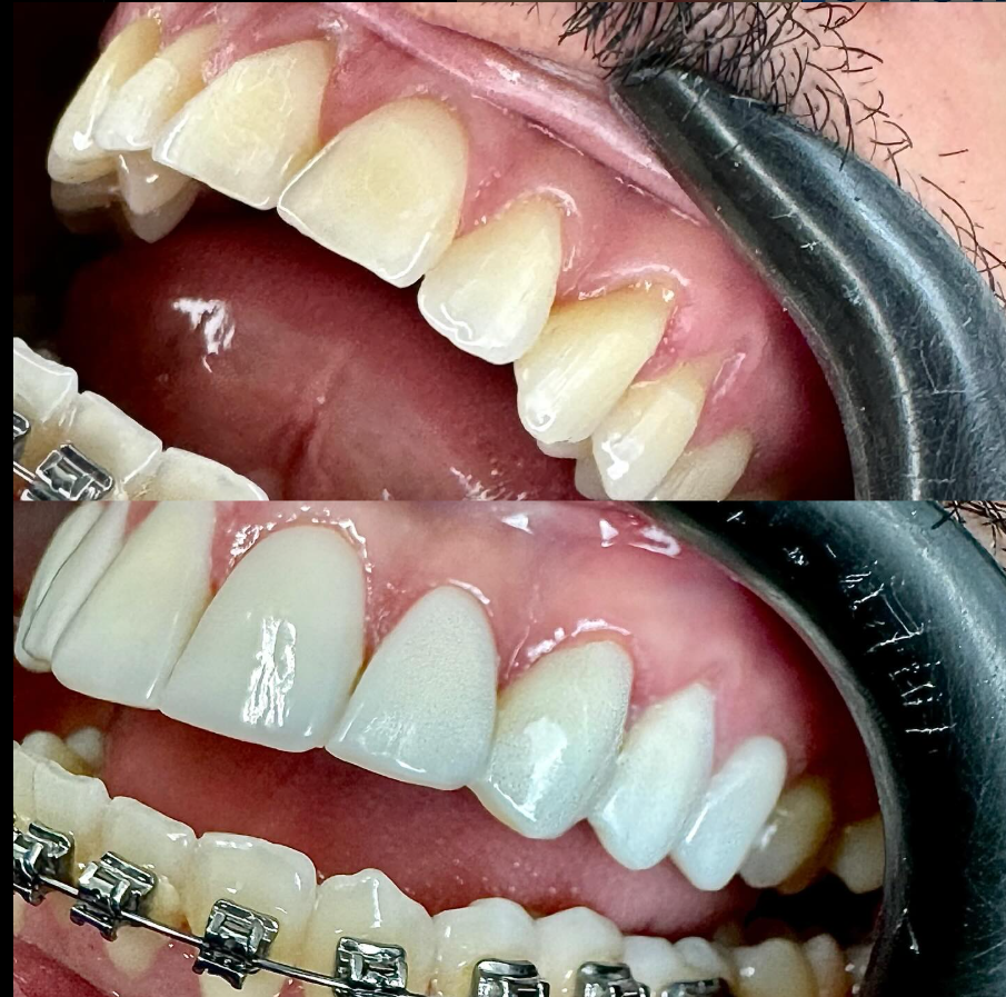 Antes e Depois